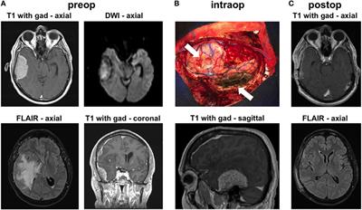 A Rare Case of Composite Dural Extranodal Marginal Zone Lymphoma and Chronic Lymphocytic Leukemia/Small Lymphocytic Lymphoma